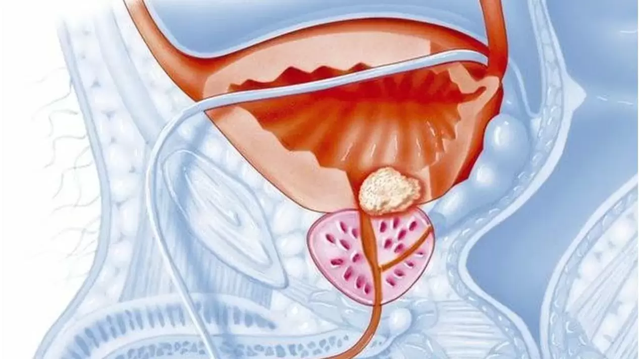 prostate diseases in men