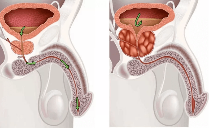 Prostatitis symptoms