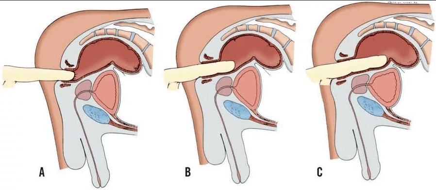 Rectal fingertip overview